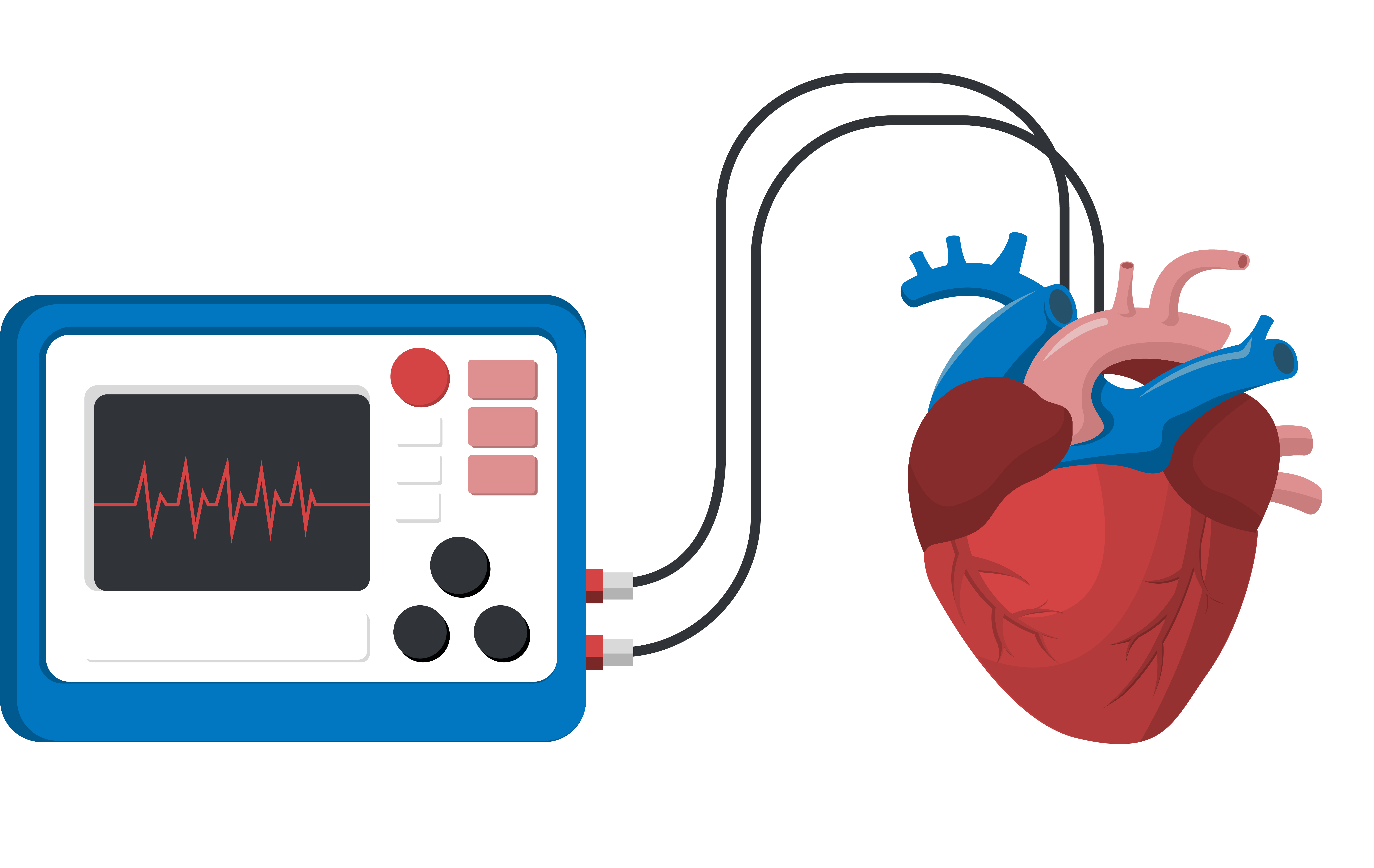 Cardioversion graphic: monitor connected to a heart
